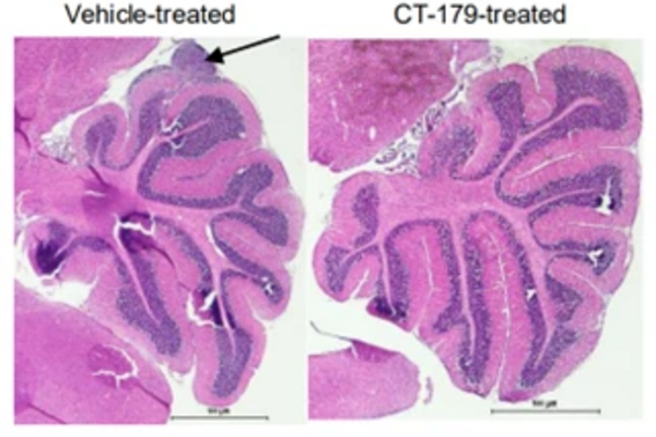 CT-179 treatment administered prior to tumour formation blocks their growth.